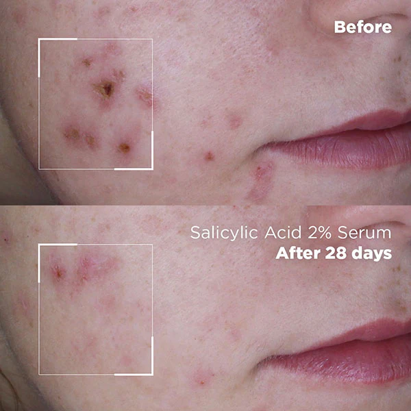Skin Republic Salicylic Acid 2% Serum 30ml - Image 7